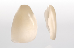 Daily maintenance of porcelain veneers