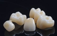 Dental veneers vs. crowns: how to choose the most suitable restoration plan for you?