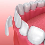 Want a Confident Smile? Dental Veneers, the One-Stop ＂Beauty＂ Savior for Multiple Dental Problems