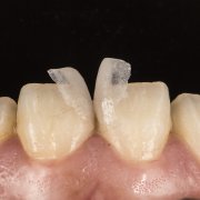 How to solve the problem of sparse teeth and large interdental spaces?
