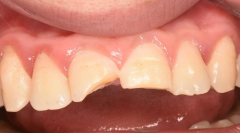Broken teeth can be rescued quickly with porcelain veneers!