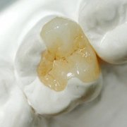 Advantages of Porcelain Inlay Tooth Filling