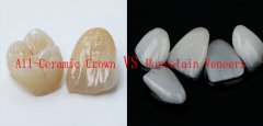 Dentist Confession Bureau: Who is the best solution for beautiful teeth between all ceramic crowns an