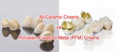  All-Ceramic Crowns vs Porcelain-Fused-to-Metal (PFM) Crowns: how to choose your crown?