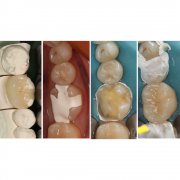 Why are more and more people choosing porcelain dental implants for dental fillings? The answer is he