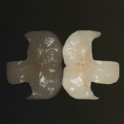 Porcelain Inlay - The Most Caring Care for Teeth