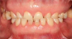 Don't Ignore the Hazards of Teeth Grinding! china-dental Teeth Grinding Guard Protects Your Oral and 