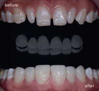The porcelain veneer cleverly seals the seams, and a smile in the morning is full of confidence!