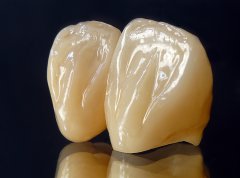 Rediscover Your Smile, Embrace Every Moment – All-Ceramic Crowns, Where Perfection Grows Naturally