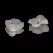 Large Cavity? End the Repair Nightmare with ＂Haute Couture for Your Teeth＂