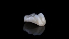 End Repeat Fillings: This ＂Invisible Armor＂ Gives Your Tooth New Life