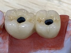 A ＂Seamless＂ New Life for a Single Tooth: How the Monolithic Abutment Crown Upgrades Implant Solu