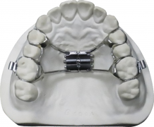 Hyrax Palatal Expander: Don't Let a ＂Narrow＂ Smile Limit Your Radiance! Narrow Palate? Expand it!