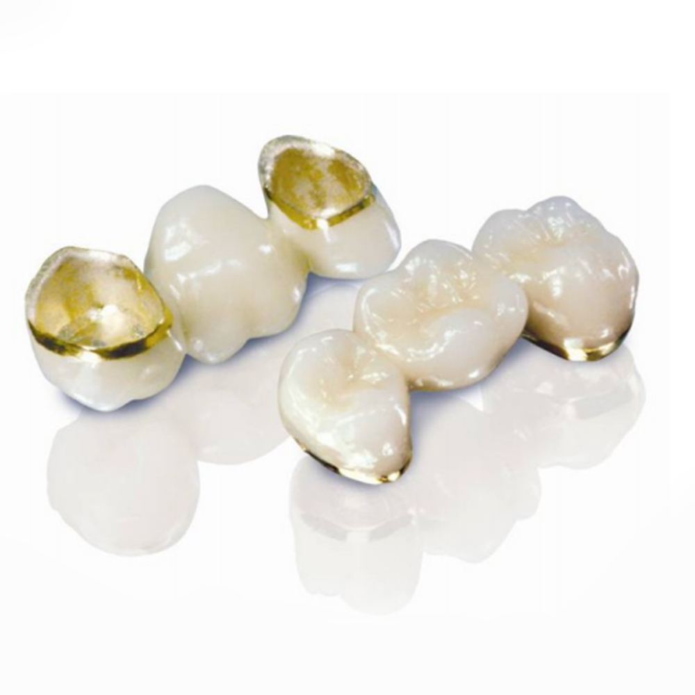 Classic and Reliable: The Enduring Value of Porcelain-Fused-to-Metal (PFM) Crowns in Dental Restorati