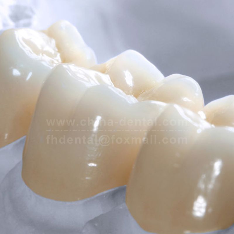 Renew Your Smile, Make It Naturally Yours Again – Unveiling the Confidence of All-Ceramic Crowns