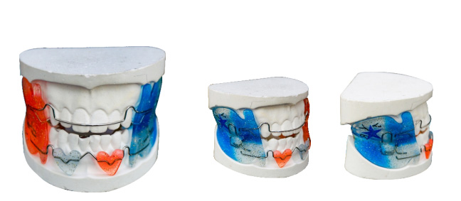 Frankel 2 Functional Appliance: Supporting Healthy Jaw Development in Children