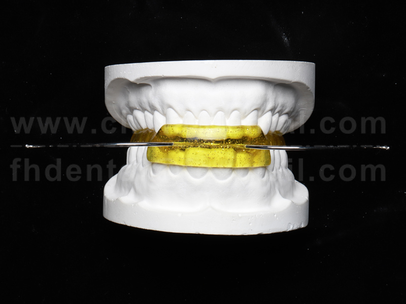 Understanding the Headgear-Activator: A Reliable Choice for Early Orthodontic Treatment in Children