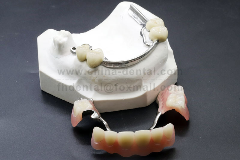 Tired of Loose Dentures? Precision Attachments Offer Unshakable Stability
