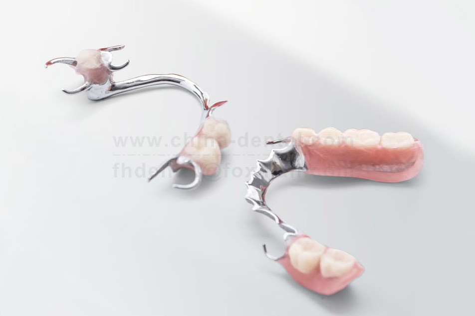 Metal Framework: The Stable Foundation of Dental Restoration