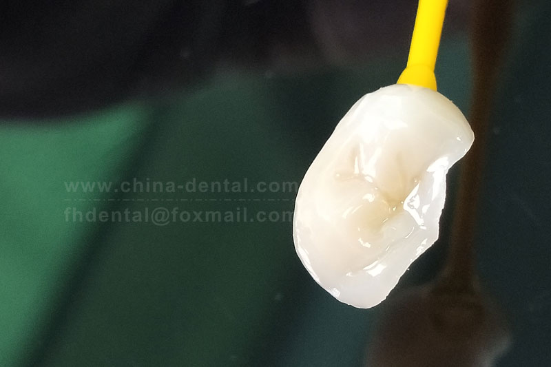 Porcelain Inlay: Restore Health and Aesthetics to Your Smile