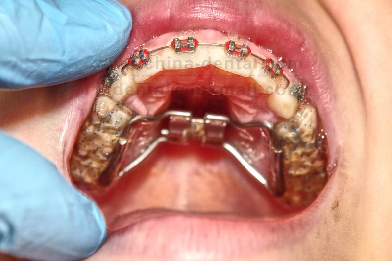Quad-Helix Expander: Laying a Solid Foundation for Aligned Teeth