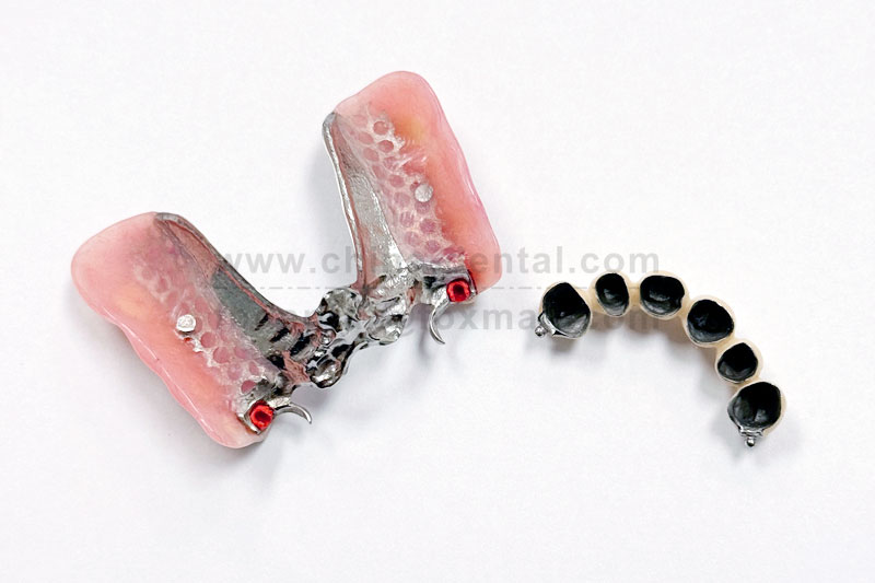 Precision Attachments: Redefining Denture Stability