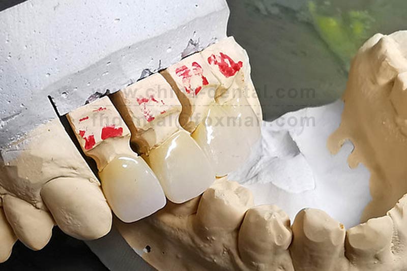 All-Ceramic Crowns: High-Strength Ceramics for Enhanced Durability and Peace of Mind