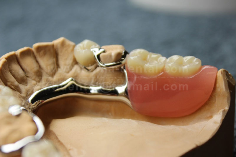 Metal Framework Dentures: A Durable and Sturdy Restoration Option