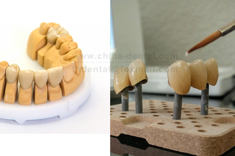 Porcelain-Fused-to-Metal Crown: A Dental Restoration Choice Balancing Strength and Aesthetics