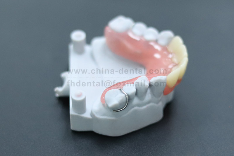 Metal Framework Removable Partial Dentures—Precise Fit, Comfortable and Durable