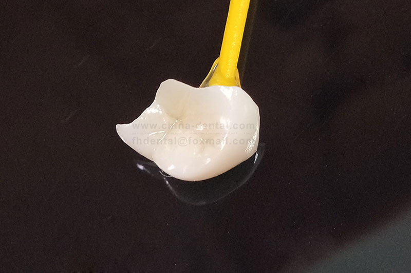 Say Goodbye to Repeated Fillings: Porcelain Inlays for Your Tooth's Long-Term Health