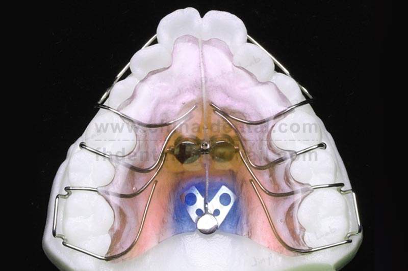 Fan-shaped Expander: A Correction Tool Designed for Crowded Anterior Teeth in Children