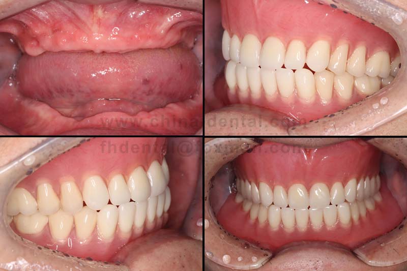 Acrylic Dentures: A Comfortable and Practical Restoration Option