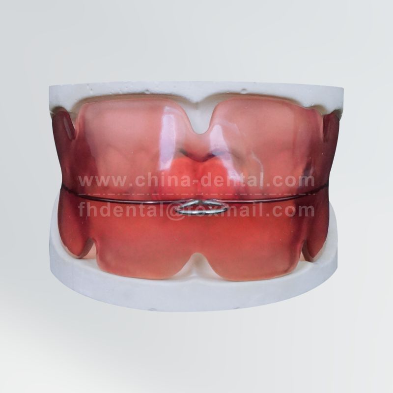 Vestibular Shield Appliance