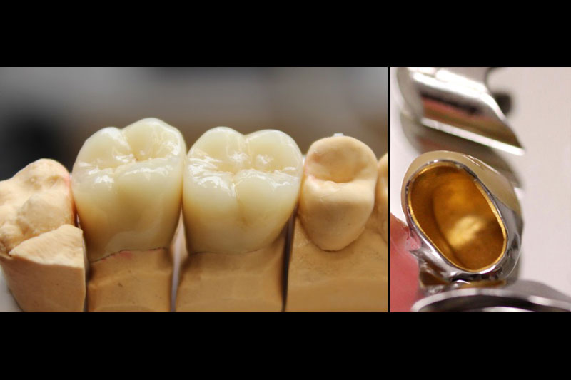 Porcelain-Fused-to-Metal Crowns: A Durable and Cost-Effective Choice for Posterior Tooth Restoration