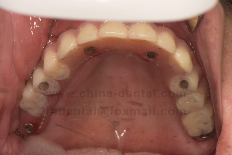 Bid farewell to the troubles of tooth loss—ALL-ON-X implants give you fixed new teeth in just one d
