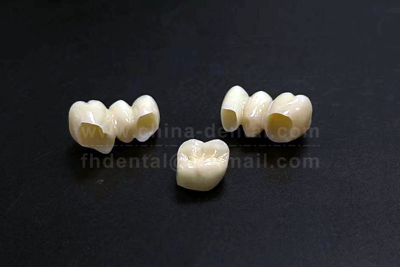 All-Ceramic Crown Fabrication: Leveraging Digital Technology for Precise and Efficient Production