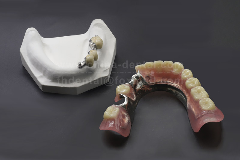 Stable Chewing, Natural Feel—Experience the Reassuring Choice of Precision Attachment Dentures