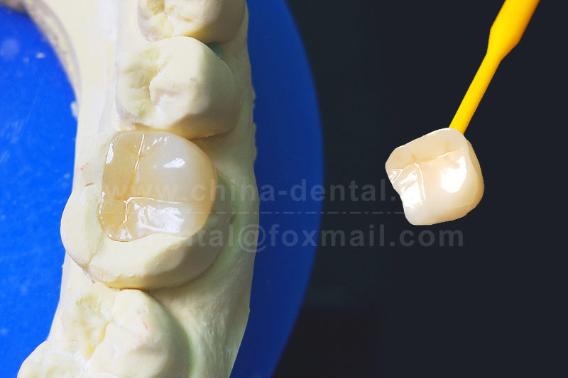 Say Goodbye to Repeated Fillings: Porcelain Inlays for Longer-Lasting Restoration