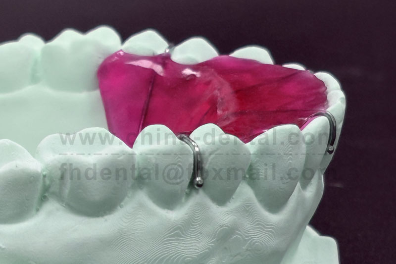 Maxillary Plane Plate – The Nemesis of Deep Overbite Correction