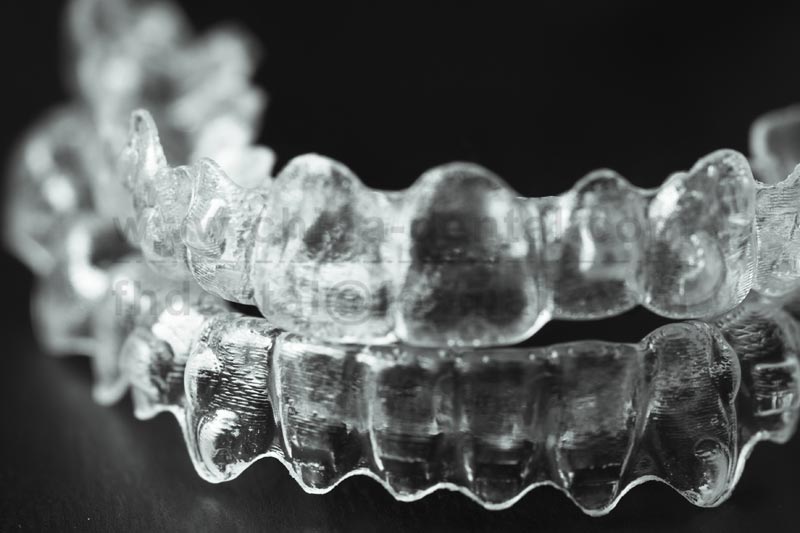 Clear Aligners: Seamlessly Integrating Orthodontics into Life
