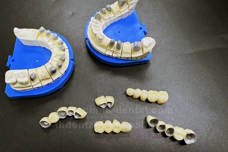 Porcelain-Fused-to-Metal Crowns: A Cost-Effective and Durable Choice for Posterior Tooth Restoration