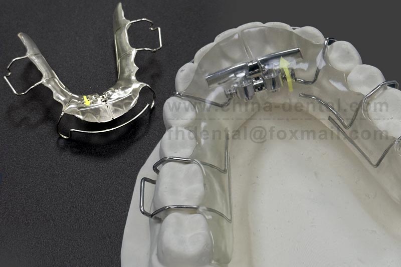 Precise Improvement of Anterior Crowding: The Fan-shaped Expander Facilitates Smile Development in Children During the Mixed Dentition Period