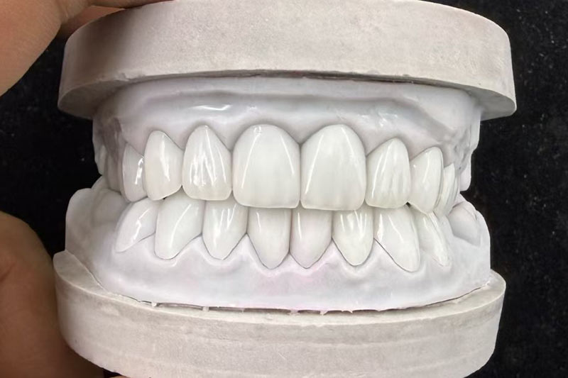 Porcelain Veneers: Let Every Brilliant Smile Shine Like a Beam of Light