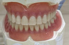 Say Goodbye to Long Waits: Suction Dentures Let You Wear and Eat on the Same Day