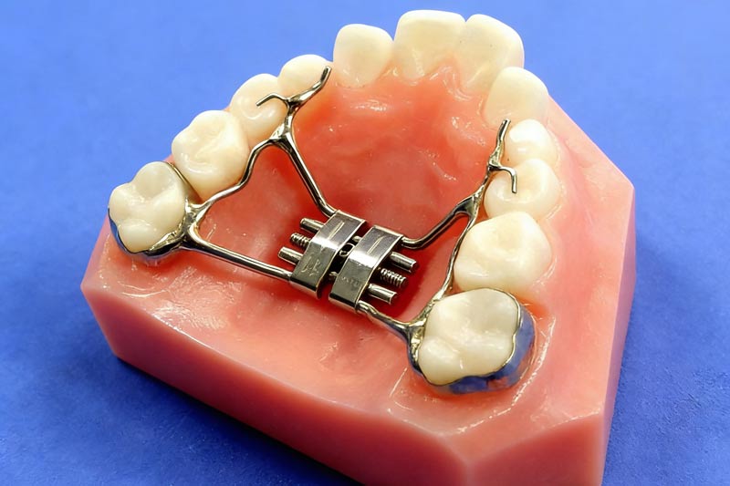 Correcting Maxillary Deficiency: The Role of the Hyrax Rapid Palatal Expander