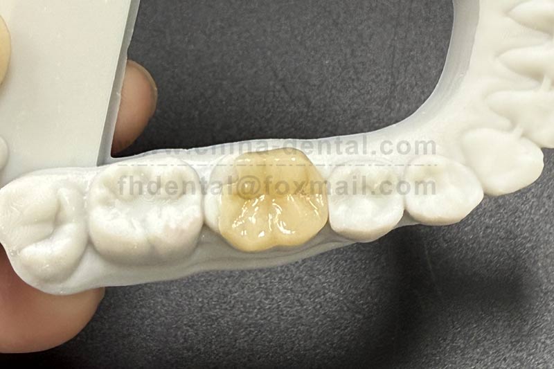 Precise Restoration: Porcelain Inlays Achieve Minimally Invasive and Aesthetic Results