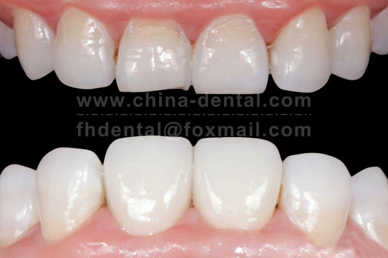 Porcelain Veneers: Giving Your Teeth a "Thin-Fit Custom Outfit" Porcelain Veneers: Giving Your Teeth a "Thin-Fit Custom Outfit"
