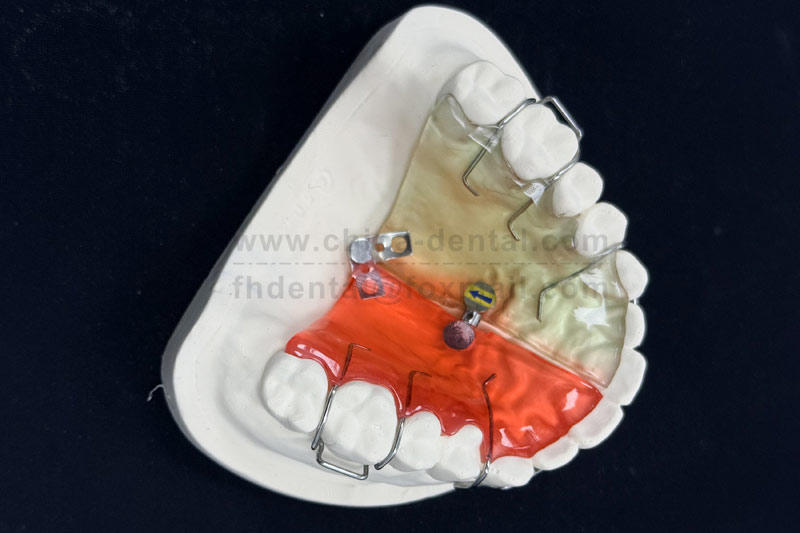 Crowded Front Teeth in Children? Try a Fan-Shaped Expander for Effective Early Intervention