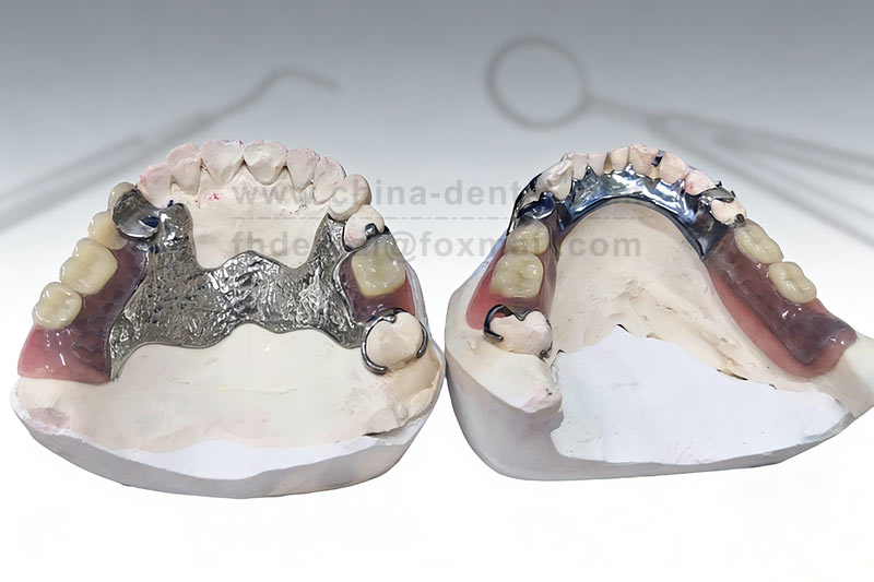  Metal Framework Dentures: A Durable and Long-Lasting Restoration Choice for Stronger Chewing